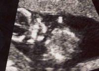 Hayden Ultrasound 1
